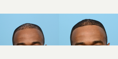 45-54 year old man treated with FUE Hair Transplant, Hair Transplant, Hair Loss Treatment, PRP for Hair Loss, NeoGraft - This 50-year-old patient wanted to restore and thicken the front hairline. Dr. Wise performed an FUE hair transplant and one treatment of PRP during the procedure to strengthen the follicles. To achieve these results, 2,220 grafts were transplanted and 1 year post-op the patient loves his results!