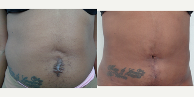 25-34 year old woman treated with Scar Removal - keloid removal plus navel reconstruction