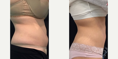 JuVaShape - Post 4 treatments, once a week, no change in diet or exercise.