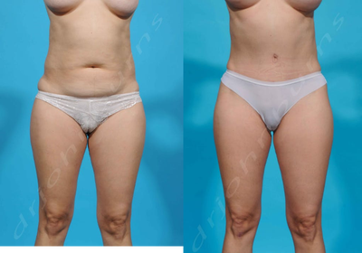 25-34 year old woman treated with Mini Tummy Tuck - 25-34 year old woman treated with Mini Tummy Tuck with liposuction of the flanks and love handles