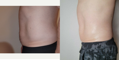 45-54 year old man treated with Cryoskin - Amazing result post 2 Cryo T Shock Sessions and 2 Cryo Drainage Massage. It is important to note that you must work out for 40 minutes after each session to gain maximum results. The Cryo T Shock is a non-invasive solution to rid the body of fat cells. Patient opted for Laser hair removal
