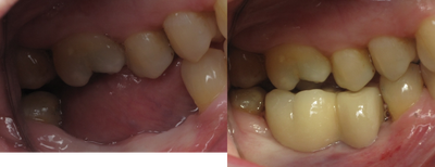 Mini dental implants support a dental bridge to replace missing teeth - Mini dental implants support a dental bridge to replace missing teeth