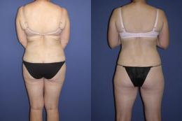 Thigh Lift - 
	Thigh Lift
