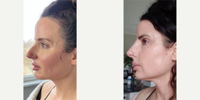 25-34 year old woman treated with Cheek Fillers, Thread Lift, Microneedling RF, PlasmaPen - Some patients dont just come for the results  they come for the relationship. Since 2022, this incredible patient has trusted me time and time again to be part of her journey to becoming the best version of herself. From our very first appointment, we built something special  a bond rooted in trust, communication, artistry, and real results.Together, we've tackled every one of her beauty goals with a customized plan that evolved with her needs: