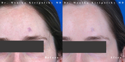 25-34 year old woman treated with Vbeam - Woman with traumatic scar on her left forehead after her first treatment with the vascular laser. She will have continued improvement after another treatment.