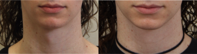 25-34 year old woman treated with Adam's Apple Reduction - 28 year old male to female transgender patient treated with Adam's Apple Reduction using submental and transoral approach..