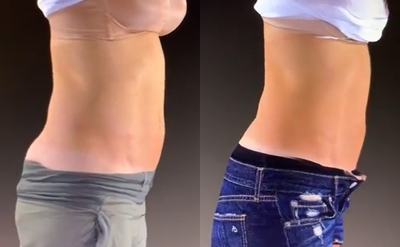 UltraShape - New York's Alizadeh Cosmoplastic Surgery team uses the entirely nonsurgical treatment to reduce bulges for a slimmer look. Contact us to discover how each session is customized to the patient. Link in bio.