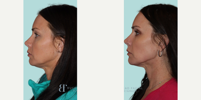 Woman treated with Emface - 3 months post Emface treatment by our Nurse Practitioner Johanna and the results speak for themselves! Emface goes beyond surface-level beauty, promoting collagen production and rejuvenating your skin. Emface delivers stunning results that last. Experience the transformative power of Emface and unlock newfound confidence in your skincare journey.