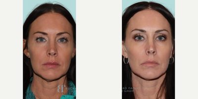 Woman treated with Emface - 3 months post Emface treatment by our Nurse Practitioner Johanna and the results speak for themselves! Emface goes beyond surface-level beauty, promoting collagen production and rejuvenating your skin. Emface delivers stunning results that last. Experience the transformative power of Emface and unlock newfound confidence in your skincare journey.