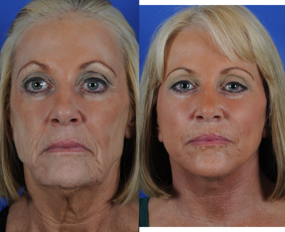 Procedures: Full Face - Neck Lift, Submentoplasty, Lower Blepharoplasty, Fat Transfer to Cheeks, Periorbital and Perioral - Procedures: 1. Full Face - Neck Lift 2. Submentoplasty 3. Lower Blepharoplasty 4. Fat Transfer to Cheeks (Periorbital and Perioral)