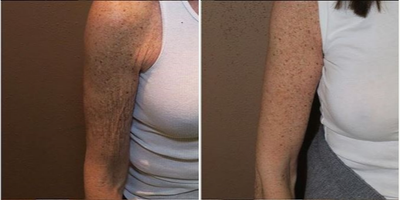 Woman treated with Arm Lift - Woman treated with Arm Lift.