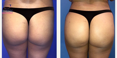 Woman treated with Liposuction, Butt Augmentation, Butt Lift - Adding more volume and contours to specific areas of your body can give you the self-confidence to wear more of the clothes you desire, and show off more of your bodys natural plump. Here we talk about 3 different ways (invasive and non-invasive) to achieve that booty youve always dreamed of.