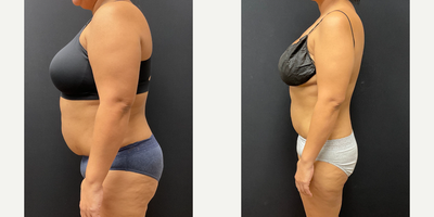 Woman treated with Semaglutide - Woman treated with Semaglutide
