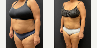 Woman treated with Semaglutide - Woman treated with Semaglutide