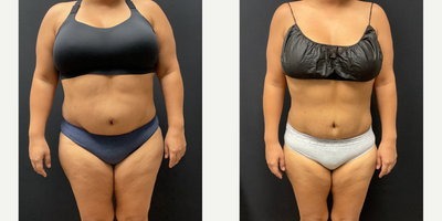 Woman treated with Semaglutide - Woman treated with Semaglutide
