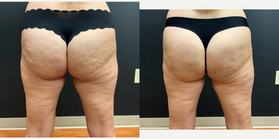 45-54 year old woman treated with Qwo - After 2 treatments of QWO for cellulite