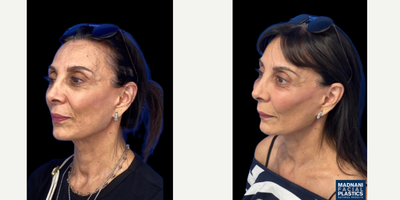 65-74 year old woman treated with Eyelid Surgery, Cheek Augmentation - 68 y.o female who was concerned with tired eye appearance and hollowness of her mid face. She underwent transconjuctival lower blepharoplasty with skin pinch and facial fat transfer of cheek, tear trough and nasolabial folds under local anesthesia. At 1 month post-op, her eye bags are completely gone and her mid face is volumized resulting in a youthful appearance.