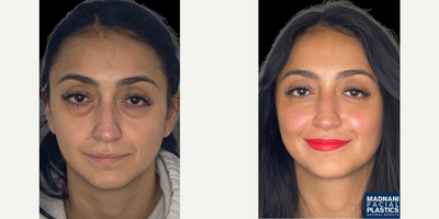 25-34 year old woman treated with Eyelid Surgery, Cheek Augmentation - 30 y.o female who was concerned with tired eye appearance and hollowness of her mid face. She underwent transconjuctival lower blepharoplasty with skin pinch and facial fat transfer under local anesthesia. At 5 months post-op, her eye bags are completely gone and her mid face is volumized resulting in a youthful appearance.