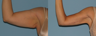 Brachioplasty and VASER LipoSelection of her upper arms.  - 
	Gender: Female Post-op Timeline: 4 months post op
