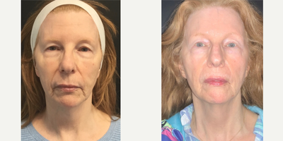 55-64 year old woman treated with NeoGen Plasma, Restylane, Lip Fillers, Dysport, Botox - 60 Days following Neogen Plasma Tx. Immediately after Restylane Kysse lip filler for a subtle enhancement. Results from Neogen continuing to build for 12-24 months.