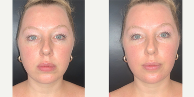 25-34 year old woman treated with Chin Filler, Restylane Defyne - 1 Syringe of Restylane Defyne in the chin for chin augmentation and more projection.