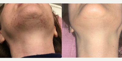35-44 year old woman treated with Laser Hair Removal - 6 sessions of Laser Hair Removal done with the Lumenis LightSheer XC.