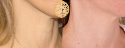 45-54 year old woman treated with Pelleve - Pelleve can be used to tighten the neck and reduce wrinkles as well.