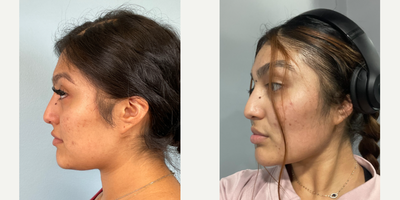 18-24 year old woman treated with Buccal Fat Removal, Jawline Sculpting, Radiesse - 18-24 year old woman treated with Buccal Fat Removal, Jawline Sculpting, Radiesse