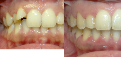17 or under year old woman treated with Clear Braces - Dental Problem(s): Class II Div II malocclusion. Space deficiency on the upper and lower arches. Impacted Upper Right Canine. Ectopically Erupting Upper Left Canine. Deep Overbite. Flared upper lateral incisors.

Plan: Comprehensive orthodontic treatment with fixed appliances. Non Extraction approach to give the patient a nicer and fuller smile. Bring upper left and right canines into the arch.Open the bite, establish ideal class one occlusion with ideal overbite and overjet. Create a beautiful and attractive natural smile.

Result: Ideal Class I occlusion was established with ideal overbite and ovejet. Upper left and upper right canines were aligned and brought into the arch. Patient was placed on lower fixed and upper removable retainers.
