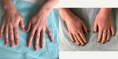 45-54 year old woman treated with Ellanse - This lady complained she didnt like the look of her hands. She thought they looked bony with veins evident. She had stopped wearing rings as she didnt want to draw attention to them. We agreed the best course of action would be the biostimulator Ellans S injected with just 1 needle insertion and a blunt cannula. It should last her about 18 months. This is a remarkably comfortable procedure and the results can be seen immediately but always improve when biostimulators are used. The after photo is 8 weeks later. As you can see she was wearing nail varnish and rings again.