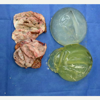 45-54 year old woman treated with Breast Lift with Implants, Capsular Contracture Treatment, Breast Implant Revision - 54 year old female from Hollywood, Florida 5 months after exchange of implants to smaller size with capsulectomies and a breast lift (mastopexy) performed by Dr Sam Gershenbaum. She presented with subglandular 550cc implants, ruptured on the left as well as Baker III capsular contracture and sagging of her breasts. Her breasts were hard and uncomfortable. Full intact capsulectomies were performed with exchange of implants to 330cc placed now under the muscle along with a bilateral breast lift. The photo shows her ruptured implant along with very calcified capsules. Now, five months later, her breasts are soft, comfortable and a more appropriate size. Her scars are healing excellent and will continue to fade over the months ahead. She is extremely happy with her results.