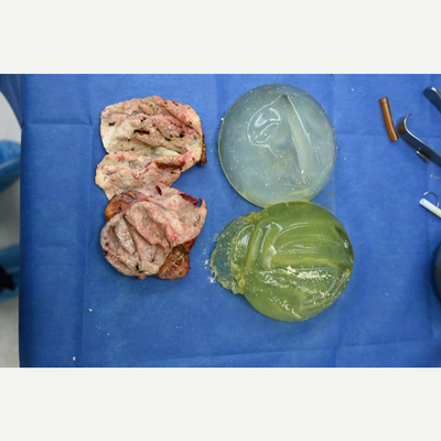 45-54 year old woman treated with Capsular Contracture Treatment, Breast Implant Revision, Breast Lift with Implants - 54 year old female from Hollywood, Florida 5 months after exchange of implants to smaller size with capsulectomies and a breast lift (mastopexy) performed by Dr Sam Gershenbaum. She presented with subglandular 550cc implants, ruptured on the left as well as Baker III capsular contracture and sagging of her breasts. Her breasts were hard and uncomfortable. Full intact capsulectomies were performed with exchange of implants to 330cc placed now under the muscle along with a bilateral breast lift. The photo shows her ruptured implant along with very calcified capsules. Now, five months later, her breasts are soft, comfortable and a more appropriate size. Her scars are healing excellent and will continue to fade over the months ahead. She is extremely happy with her results.