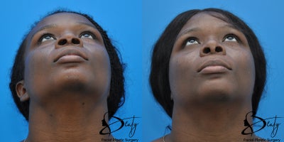 21-30 year old woman treated with Alarplasty, Brow Lift, Facial Fat Transfer - 21-30 year old woman treated with Alarplasty, Brow Lift, Facial Fat Transfer