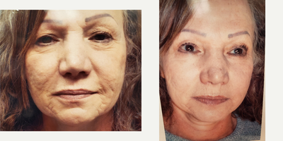 55-64 year old woman treated with Morpheus8 - a woman in her 60s with extensive ridges and deep acne scarring 3 months after second Morpheus treatment
