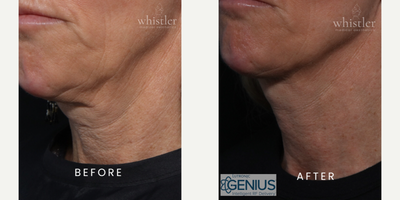 35-44 year old woman treated with Genius - Three (3) sessions of Genius Microneedling RF to tighten laxity in the skin, sculpt the neck and jawline