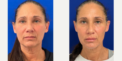 45-54 year old woman treated with Dermal Fillers - Patient was treated with Sculptra in the cheeks and jawline. This is after 1 treatment.