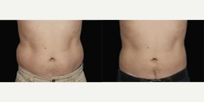 Man treated with CoolSculpting - Man treated with CoolSculpting. Patient is shown before and 90 days after one treatment.