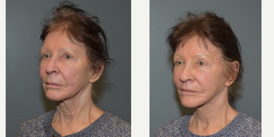 75 and up year old woman treated with ActiveFX - This woman is 76 years old, 5'2 and 125 pounds. She presented requesting lower face and neck lift. She also had a sub-nasal lip lift and CO2 laser resurfacing of her central face.