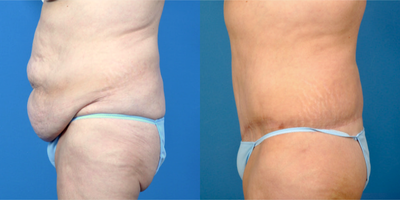 45-54 year old woman treated with Tummy Tuck - Patient lost 60 pounds, diet and exercise. Circumferential Abdominoplasty (Lower Body Lift) 9 months ago.