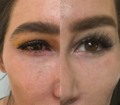25-34 year old woman treated with Mesotherapy - This relaxes the fine lines and crepey skin beneath the eyes.