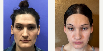Patient treated with Rhinoplasty, Septoplasty - Septorhinoplasty (Closed) with Cartilage Grafts and Weirs - 25 to 34 year-old female patient is 3 months post-op from Facial Feminization surgery. Her procedures included: Modified Coronal Forehead Lift, Orbital Bony Contour, Chin Reduction and Contour, and Septorhinoplasty (Closed) with Cartilage Grafts and Weirs.