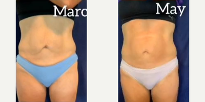 Woman treated with Emtone - Check out my latest patient who completed her Emsculpt Neo and Emtone treatments a month ago. She didn't like her saggy skin around the belly button after having 2 kids and wanted to cut fat and shrink the sagginess.