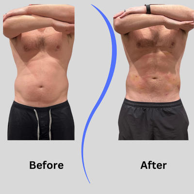 25-34 year old man treated with Body-Jet Liposuction - Abs Liposuction with Funsculpting