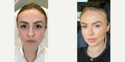 25-34 year old woman treated with Thread Lift - NEW MOM, NEW LOOK Our patient recently became a mom and now she's here to have the amazing MIRACU MAKEOVER. These incredible threads yield the strongest hold, so they're more than up to the task of this makeover. Our patient already looks very youthful, so this is all about accentuating her existing beauty to get a natural result. 