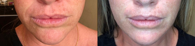 35-44 year old woman treated with Injectable Fillers - Aquagold Finetouch treatment with Juvederm and Botox.