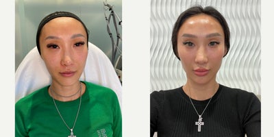 Subtle fillers  Stunning results - My patient visits me annually for my signature heart-shaped facial sculpting look- trusting only my expertise to keep her looking youthful, balanced, and sculpted. With these regular maintenance treatments, she continues to defy aging and maintain her timeless look. This time, she wanted to fine-tune key areas for a refreshed and defined appearance. Starting with her temples, I filled in hollowness to support her brows and create a more harmonious contour. Next, I enhanced her cheeks for a structured, sculpted look and added filler to her jawline to sharpen and define her natural 90 angle. And guess what guys? The chin is in! I added some subtle but much needed projection to complete the heart-shaped symmetry she desired.I used filler to address her brows, for added bone definition and lift, enhancing her overall facial balance. Finally, her lipsalready gorgeouswere given a subtle plump for a soft, natural enhancement and a keyhole pout. The result is a stunning, refreshed appearance with precise sculpting that highlights her natural beauty while achieving her goals. This is exactly why she chose me. Other providers who are not as experienced cannot deliver these results and often leave their patients with that overdone look. Its all about knowledge, meticulous planning, and technique. Each patients facial features vary so it is extremely important to go to a professional that takes the time to asses your features. FEMALE FACIAL SCULPTING: Chin Jawline Cheek Temples Brow Lips