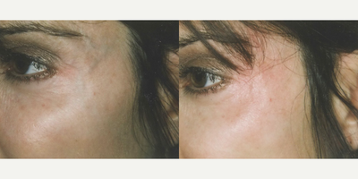 Woman treated with Pulsed Dye Laser - Woman treated with Pulsed Dye Laser