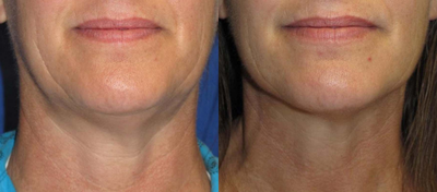 Velashape - Photos provided courtesy of Syneron, James Howton, DO