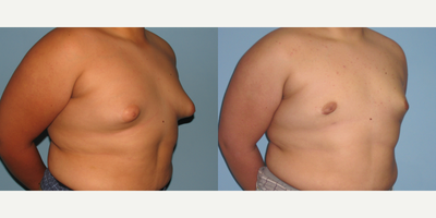 17 or under year old man treated with Gynecomastia Surgery - This 12 year old student underwent bilateral subcutaneous mastectomy and Vaser liposelection of the chest.