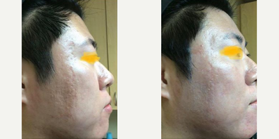 Man treated with Fraxel Laser - Man treated with Acne Scars Treatment using Fraxel Laser.